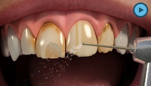 Porcelain Veneers