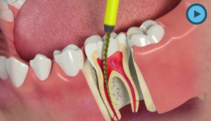 Root Canal Therapy