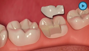 Inlays & Onlays