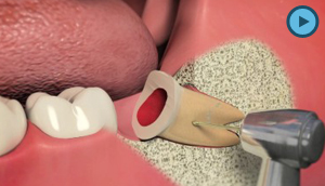 Extractions / Oral Surgery