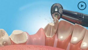 Dental Bridges
