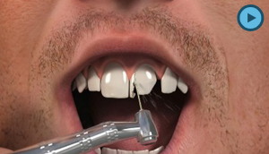 Dental Crowns