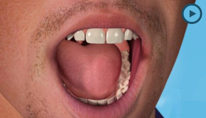 White Fillings
